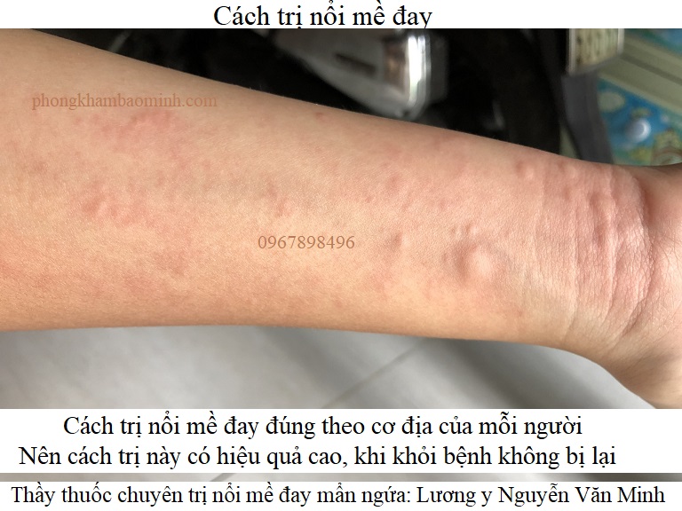 Cách trị nổi mề đay